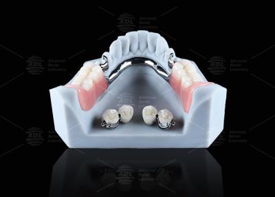 China Titanium Dental Implant Ball Attachments Comfortable Secure Denture Retention for sale