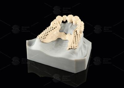 China Milled Peek Framework Customizable Digital Partial Dentures Superior Thin for sale