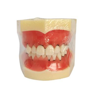 China Dental model of enduring periodontal disease to demonstrate calculus gum recession and measurement for sale