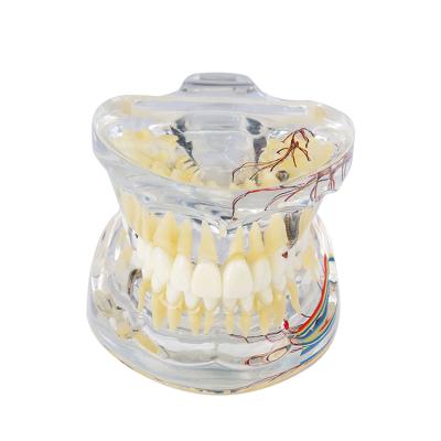 China Durable Transparent Pathologies Dental Model With Nerve Caries Implant And Pulp Poylp For Demonstration for sale