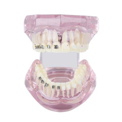 China Transparent Orthodontic Demo Model Hospital Clinic University With Ceramic And Metal Brackets for sale