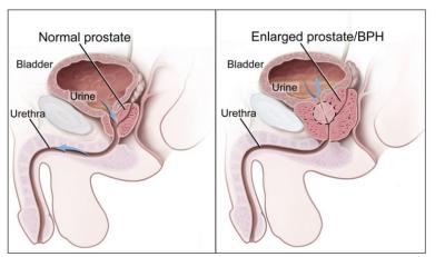 Κίνα Αρσενική χρόνια Prostatitis συσκευή επεξεργασίας/προστατική μηχανή καμία παρενέργεια προς πώληση