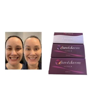 China Juvederm Injectable dermal filler Juvederm Ultra3 Ultra4 Voluma Te koop