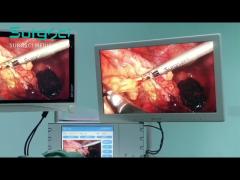 Ultrasonic Scalpel in Use | Laparoscopic Radical Resection of Sigmoid Colon Cancer | SurgSci