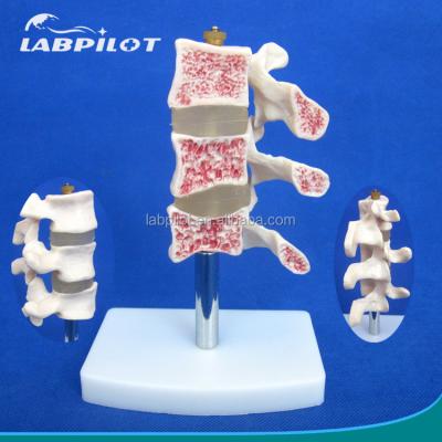 China Advanced PVC Educational Models Cutaway Osteoporosis of Spine Lesions of Lumbar Vertebra for sale