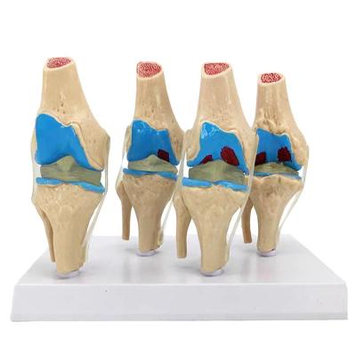 China Anatomical demonstration of Human Knee Joint Pathology Model for Medical Science for sale