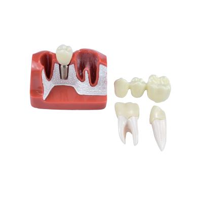 China For Patient Communication and Education 4 Times Implant Teeth Model Demonstration Tooth Model for Patient Communication and Education for sale