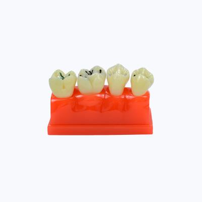 China Educational Models 4 Periods Caries Tooth Display Demonstration Tooth Model Model for Patient Communication and Education for sale