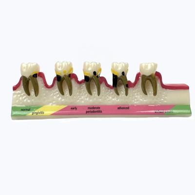 China Dental show dental model for dental caries teaching for sale