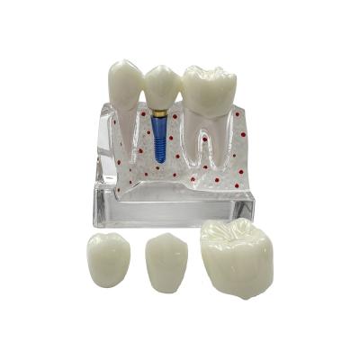 China Medical School Exhibition Dental Medicine Four Fold Transparent Resin Dental Implant Display Model for sale