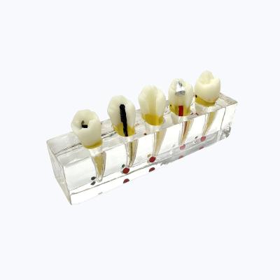 China pulp restoration doctor-patient communication dental display transparent template for sale