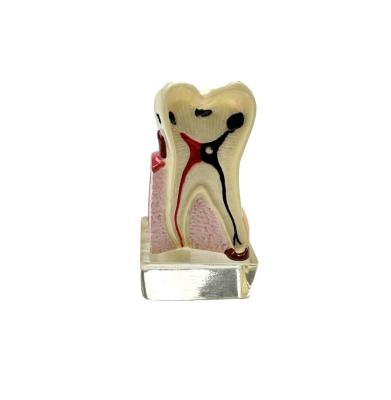 China Demostration 4 Times Complete Pathology Model Dental Model For Patient And Student for sale