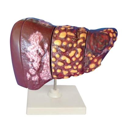 China Subject and anatomical type disease liver school and hospital medical science human model for sale