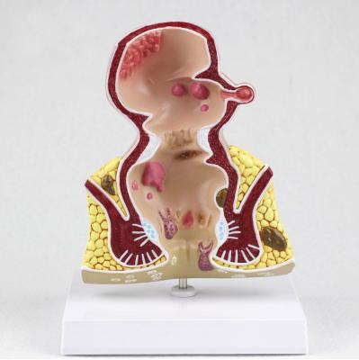 China Understanding rectal lesion Internal model of hemorrhoids of patients and external anatomy of hemorrhoids Te koop