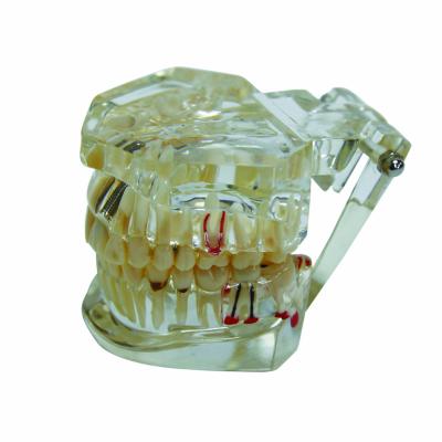 China Transparent resin Comprehensive Pathological Model dental model of transparent teeth for sale