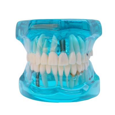 China Useful School And Hospital Premium Universal Braces Human Dental Teeth Model for sale