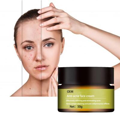 China OEM Nourishing Plant Extract Acne Dark Spots Anti - Removing Acne Scar Removal Whitening Face Cream Helps To Prevent Breakouts for sale