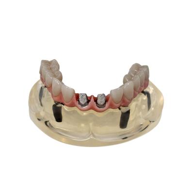 China Professional Dental Teeth Professional Hot Selling Full Acrylic Zirconia All-Ceramic Denture Upper And Lower Jaw for sale