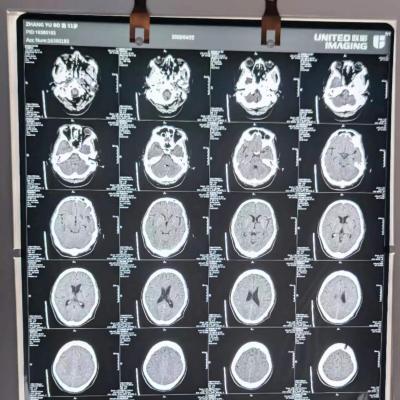 China CT/MRI Radiology Diagnose 14*17inch Fuji Film Medical Dry Imaging X Ray Films DI-HL For Fuji PIX6000 SEC 8000 Laser Printer for sale