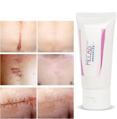 China Packing MELAO Scar Removal Gel Organic Effective Packing Fade Scar Remove Silicone Scar Repair Massaging Anti Scar Removal Gel Advanced Private Label for sale