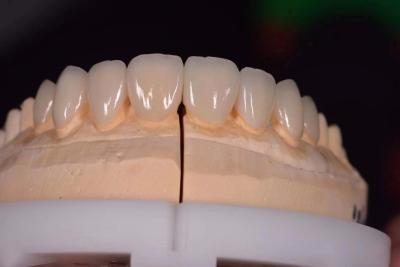 China 0.3mm IPS E.MAX Veneers Veneers de porcelana para incrustações coroas e veneers à venda