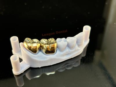 China Invertir y fundir una corona de metal completa Biocompatibilidad Dente de corona de metal en venta