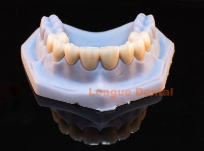 China Translucent And Durable PFZ Bridge Natural Porcelain Fused To Zirconia Crown for sale