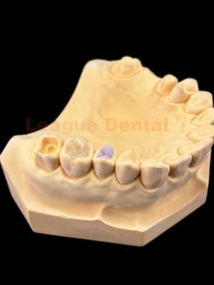 China Durable E.MAX Inlay And Onlay Lithium Disilicate Ceramic Restorations for sale