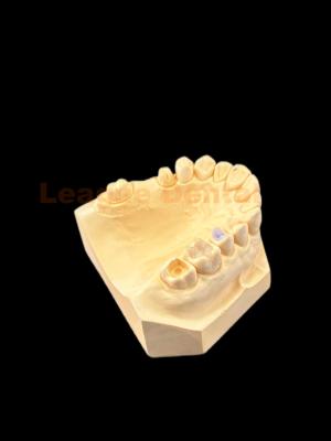 China Stärke E MAX Inlay Dental Onlay mit natürlicher Ästhetik und präzisem Fit zu verkaufen