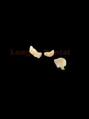 Cina Onlay estetico di zirconia di aspetto naturale Restituzione dentale Onlay in vendita