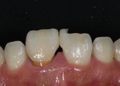 China Vorzähne Zirkonie Veneer Ultra dünne Veneer hohe Durchsichtigkeit zu verkaufen