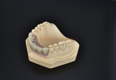 China Cementos cerámicos retenidos Implantación de corona dental Restauración estética Biocompatible en venta