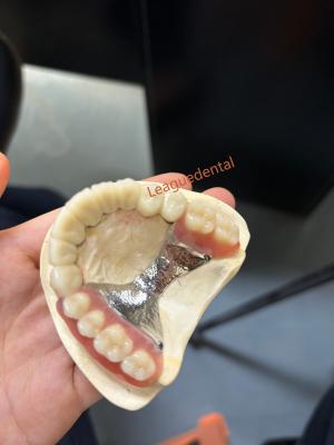 China Implantes dentales hipoalergénicos de tornillo con corona retenida para restauraciones de arco completo en venta