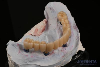 China Restauración dental Implante dental múltiple Endosseo Reemplazo de dos dientes delanteros en venta