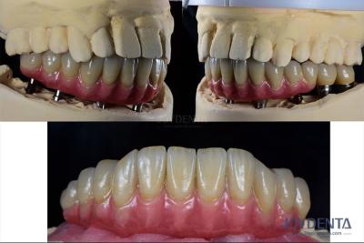 China Dental Reconstruction Multiple Teeth Implant Titanium Prosthetic Connection Internal for sale