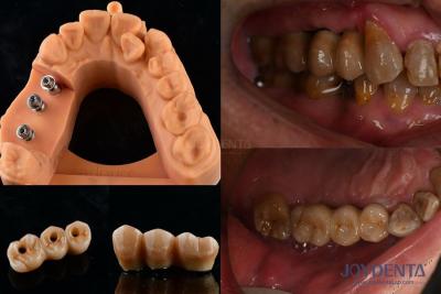 China Estabilidad de color ultra dura Implante dental Corona OEM fácil de mantener duradero en venta