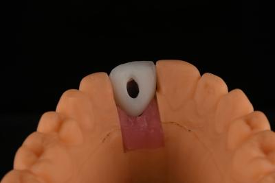 China Implantes dentais de titânio de superfície rugosa Cirurgia para substituição de dente frontal à venda