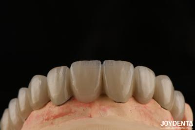 China PFM Porcelain Fused to Metal Crowns and Bridges Seamless Bonding for Natural Smiles for sale