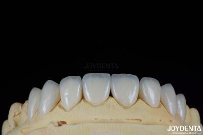 China Long-lasting And Stain Resistant Dental Veneers With Personalized Shades For Natural Teeth for sale