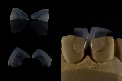 China Comfortabele tandheelkundige veneers Sterke binding met tandglazuur voor een veilige pasvorm Lichtgewicht en glad voor optimaal patiëntcomfort Te koop