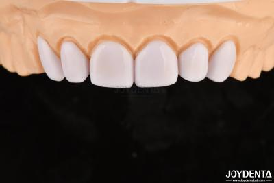 China Dental Veneers for Misaligned Teeth Biocompatibility And Gentle On Oral Tissues for sale