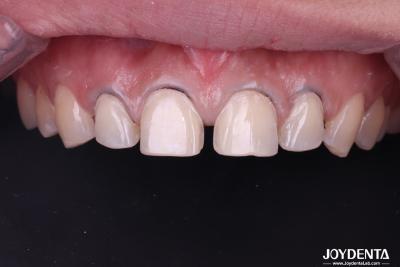 Cina Carpetti di porcellana dentale di aspetto reale Carpetti di ceramica per denti per denti anteriori in vendita