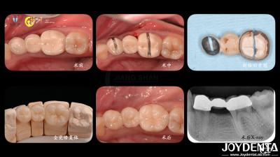 China Tailored Dental Zirconia Crown Biocompatibility Comfort Customization For Optimal Patient Experience for sale