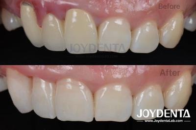 China Painless Procedure BOPT Dental Technique for Accurate Tooth Preparation for sale