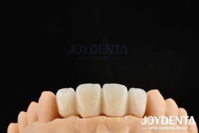 Cina Tecnica di preparazione orientata biologicamente BOPT per una preparazione dentale accurata in vendita