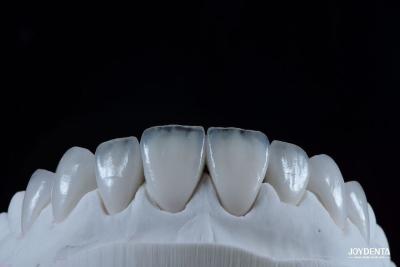 China Natürlich aussehende Emax Porzellan Veneer Komfortabel passend Ultra dünne Emax Veneers zu verkaufen