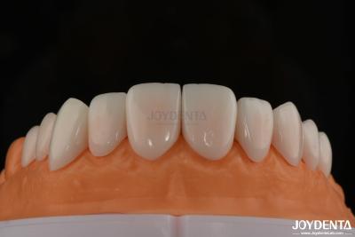 Cina A1-A4 Ips Emax Press Porcellana Finiture dentali resistenti alle macchie Forma personalizzabile in vendita