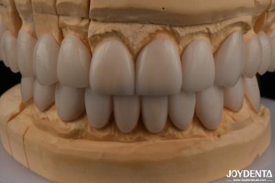 China 0.3 mm Dikte Ips Emax Veneers Keramische veneers Voorzijde Achterzijde Restauratie Te koop