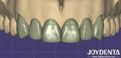 China 3D Printing Virtual Digital Wax Up Seamless Compatibility With Other Dental Software for sale