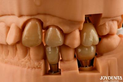 China Customizable Implant Crown and Bridge Achieve a Natural Look with Long-lasting Results for sale